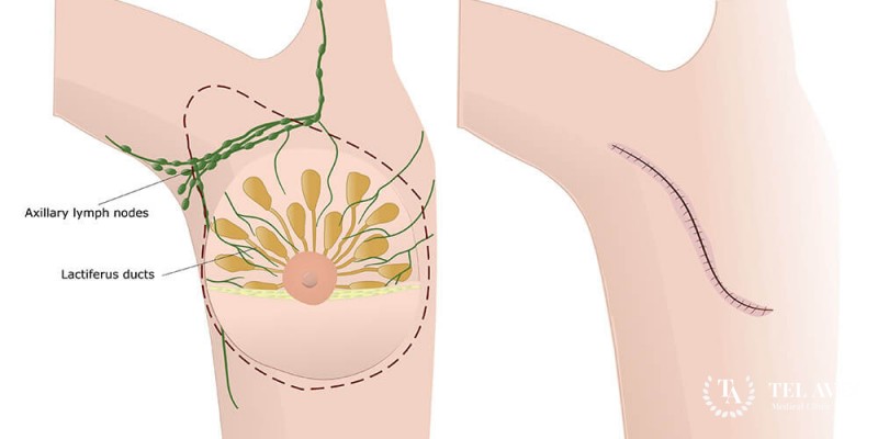 Mastectomy