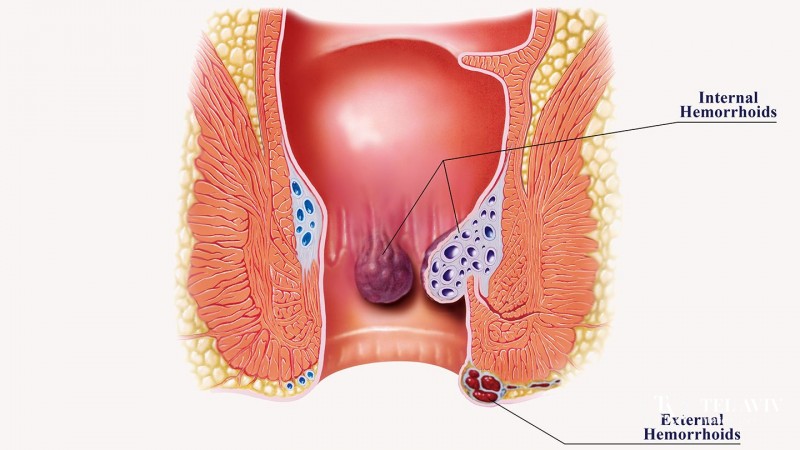 Anal diseases such as hemorrhoids, fissures and fistulas