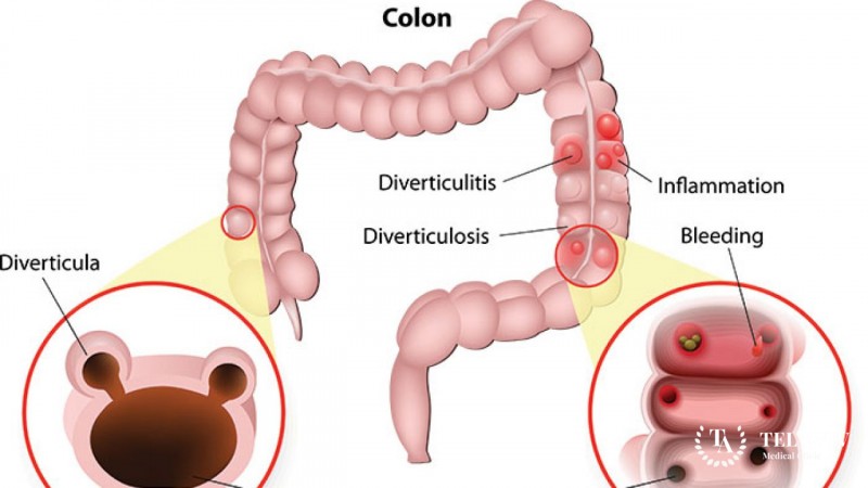 Diverticulitis