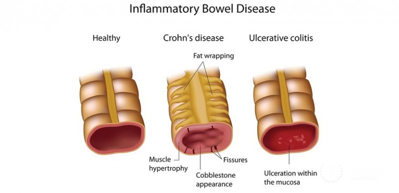 Inflammatory bowel diseases, Crohn's disease and ulcerative colitis