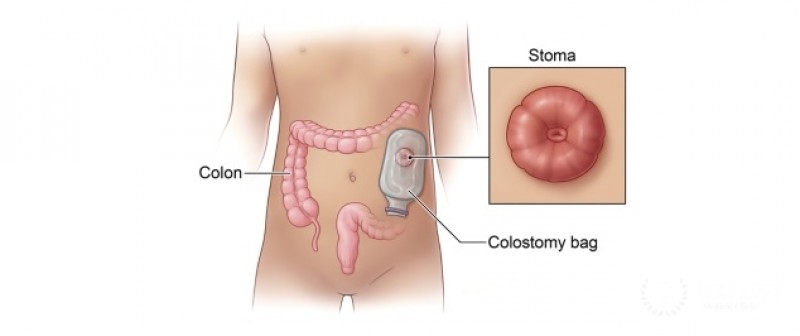 Laparoscopic colectomy