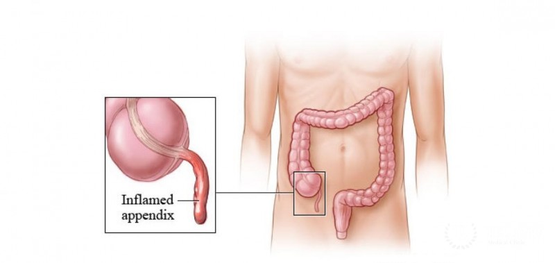 Appendix removal