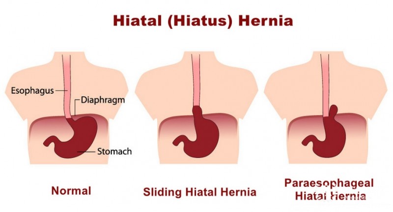 Diaphragmatic hernia - prevention and treatment