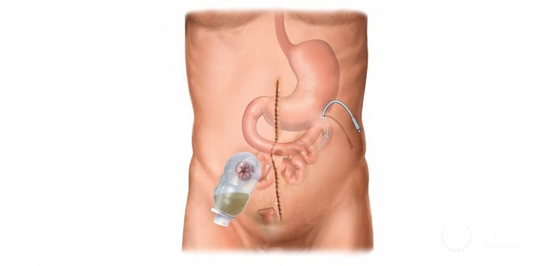 Laparoscopic small bowel resection