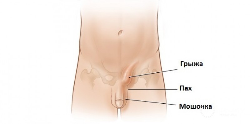 Паховая грыжа – симптомы, причины и лечение