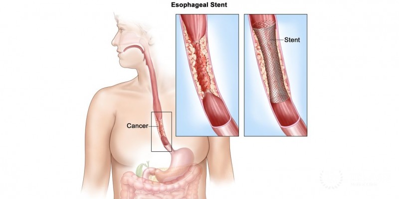 Surgery for Esophageal Cancer