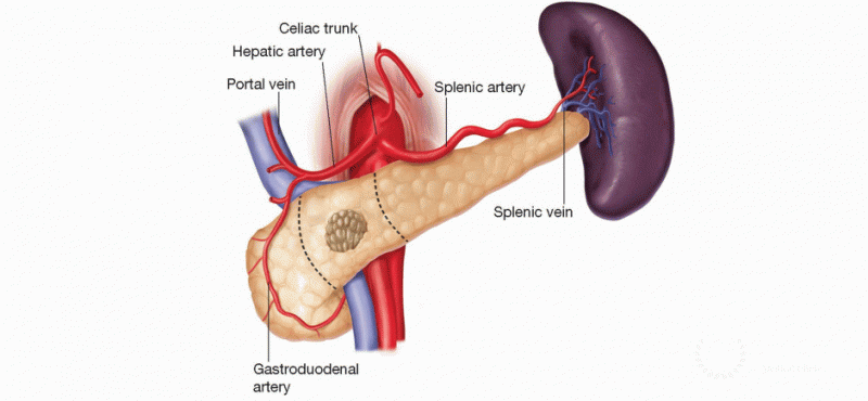 Central Pancreatectomy