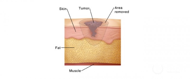 Surgery for Melanoma