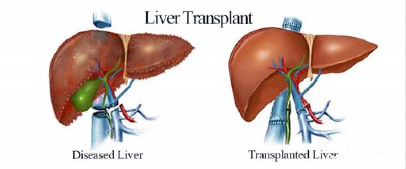 Liver transplantation