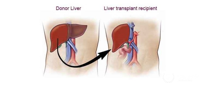 Live adult right lobe liver transplantation