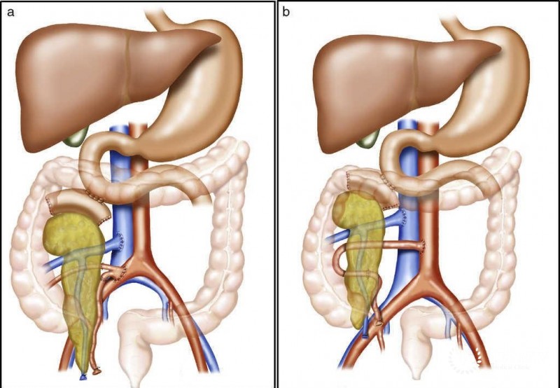 Pancreas transplantation