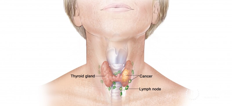 Thyroid diseases