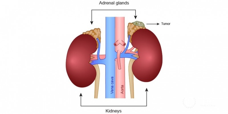 Adrenal Tumors