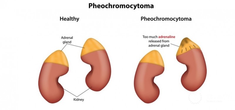 Pheochromocytoma