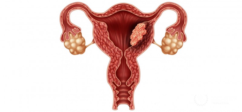 Uterine (Endometrial) Cancer