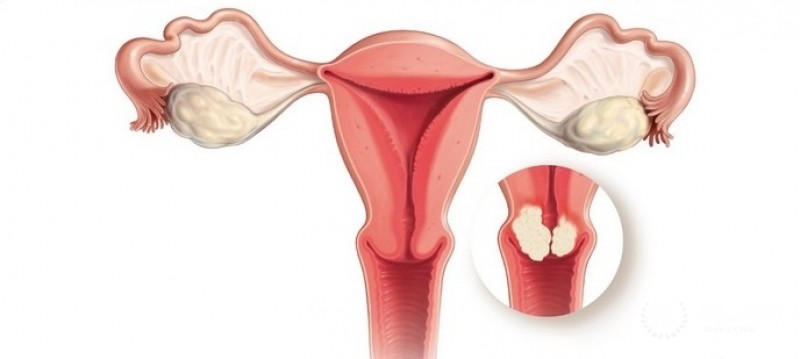 Cyst of a neck of the uterus