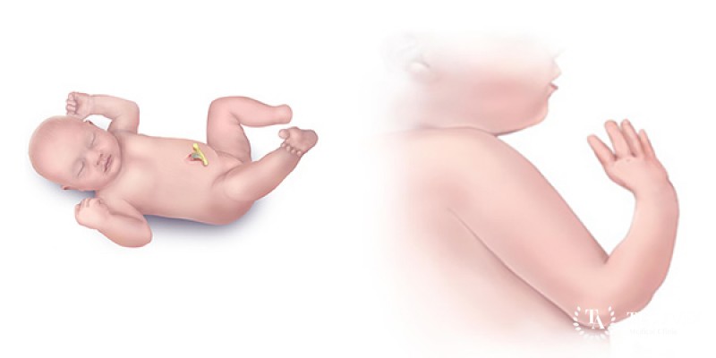 Surgery for congenital limb deformities