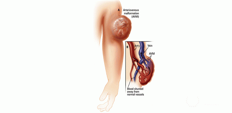 Vascular malformation