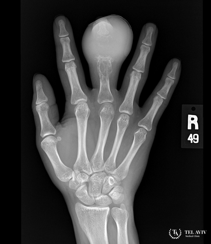Ортопедическая онкология - саркома Юинга