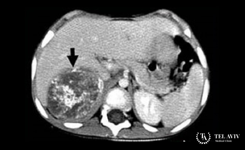 Neuroblastoma Diagnosis