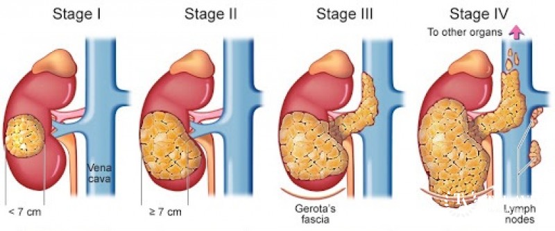 Wilms' Tumor Diagnosis and Staging
