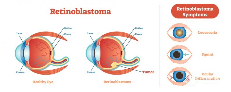Retinoblastoma Signs & Symptoms