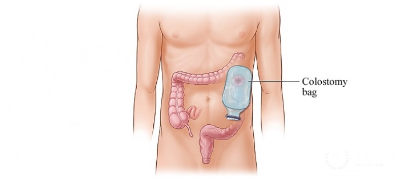 Colon Cancer Surgery