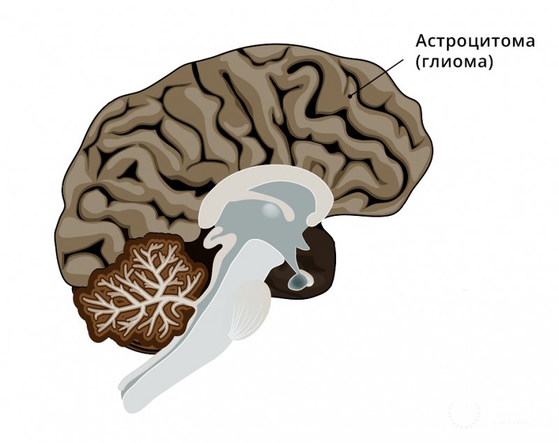 Астроцитома - что это