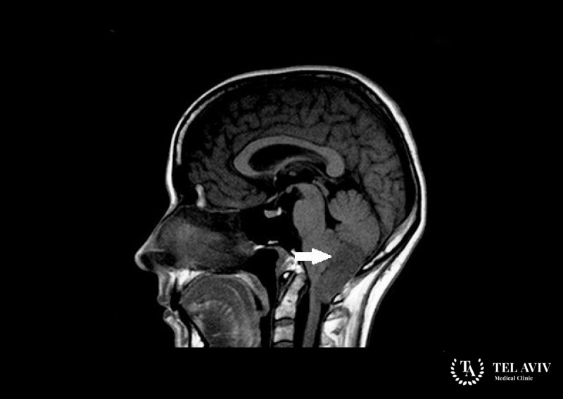 Анапластическая эпендимома - общая информация про заболевание