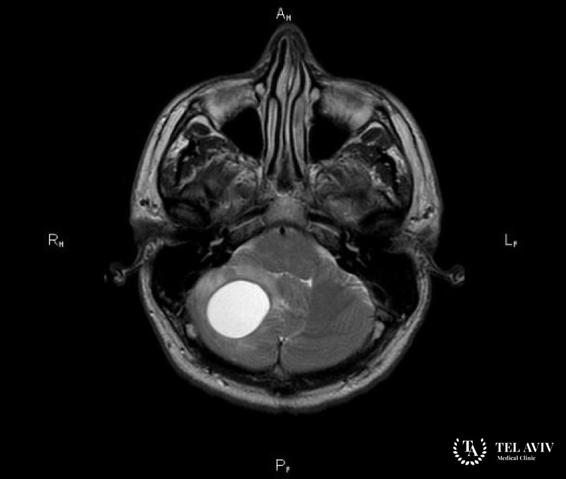 Гемангиобластома головного мозга - симптоматика, лечение