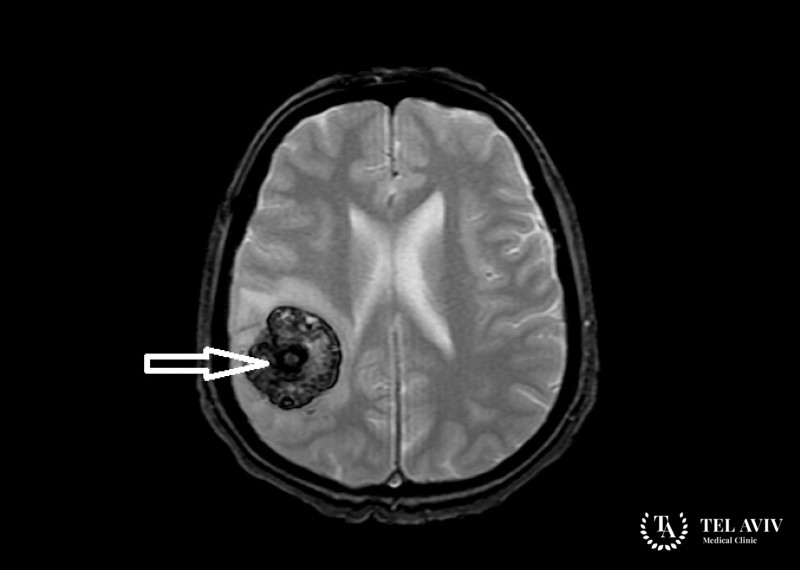 Кавернома сосудов головного мозга - полная информация
