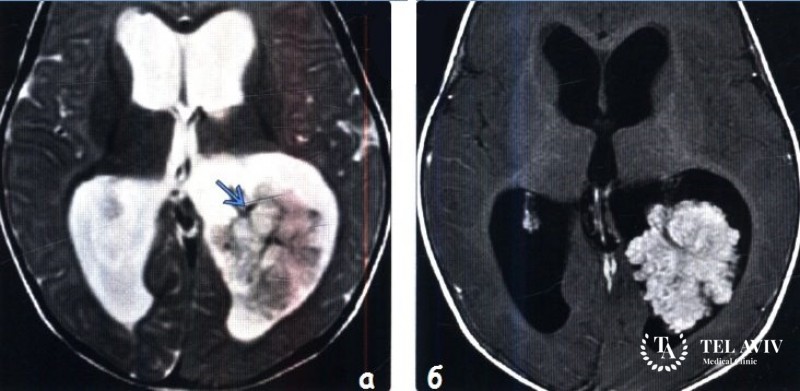 Хориоидпапиллома - симптоматика и лечение