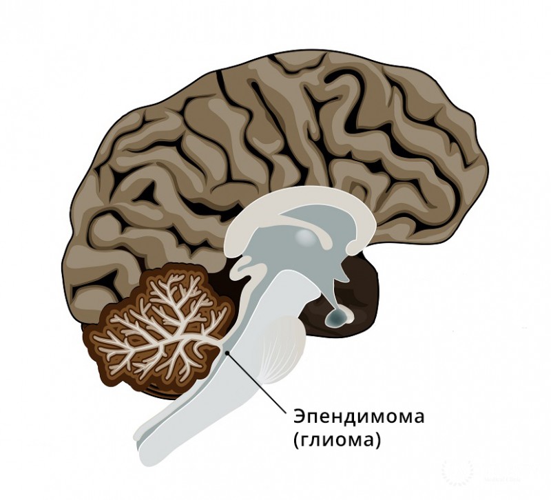 Эпендимома - что это