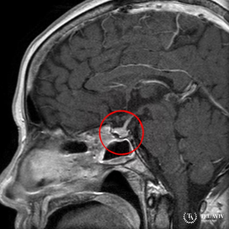 Кортикотропинома – симптомы, лечение