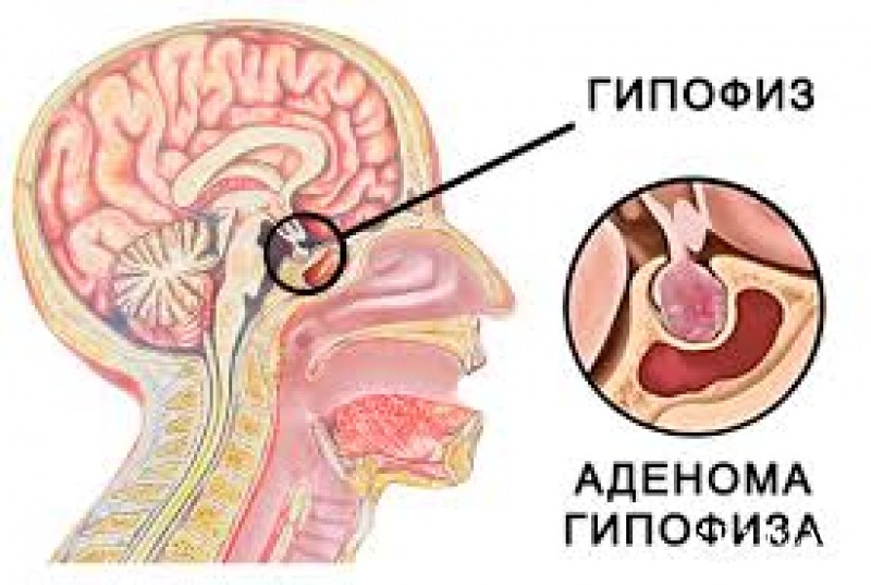 Тиреотропинома – лечение, причины развития