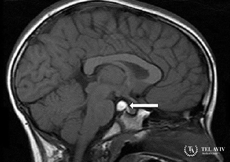Шишковидная киста в головном мозгу – симптоматика, диагностика, лечение