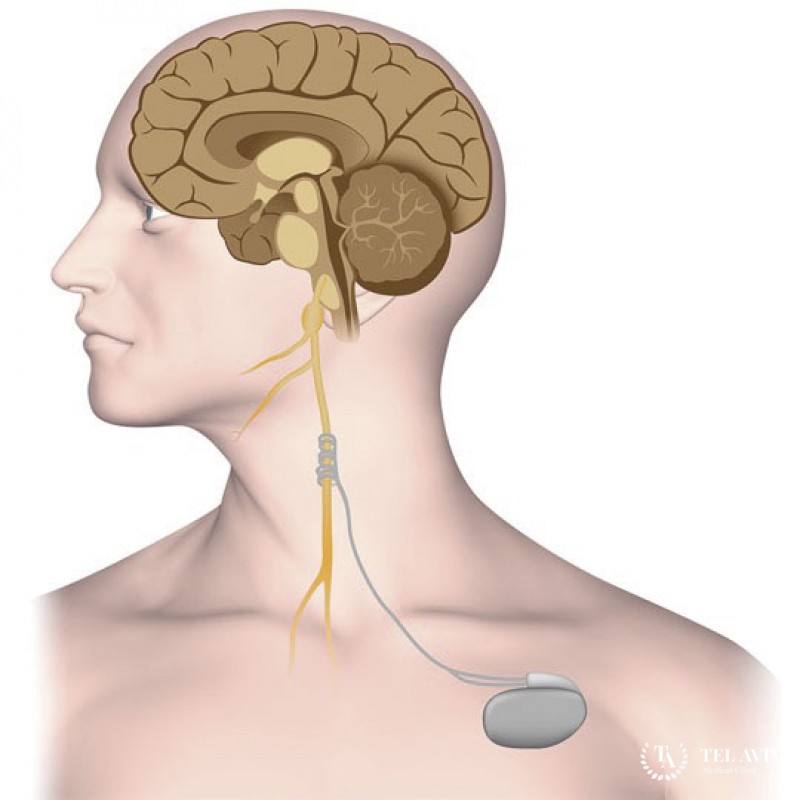 Резекция или имплантации электрода – стимуляция блуждающего нерва при эпилепсии