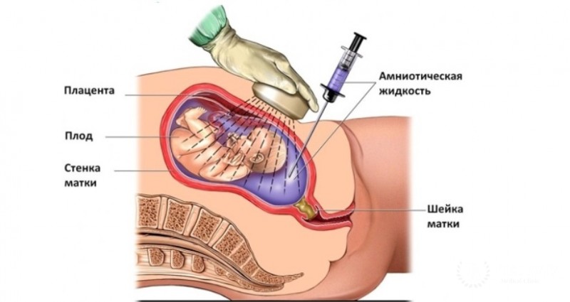 Амниоцентез - что это и для чего нужен