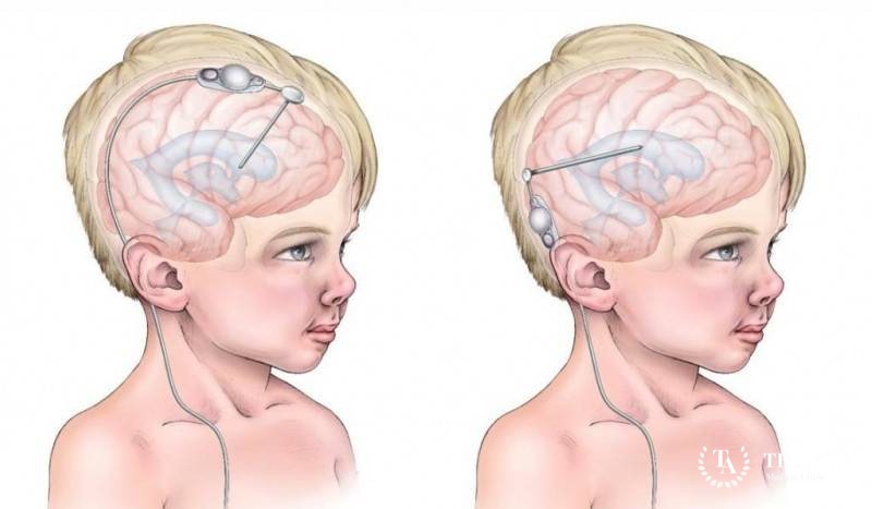 Что такое шунтирование при гидроцефалии