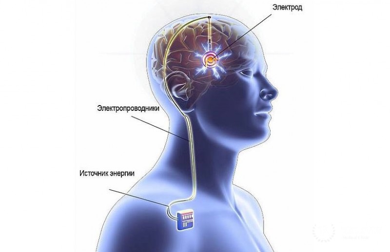 Вся информация об имплантации нейростимулятора (Таламического стимулятора) в таламус