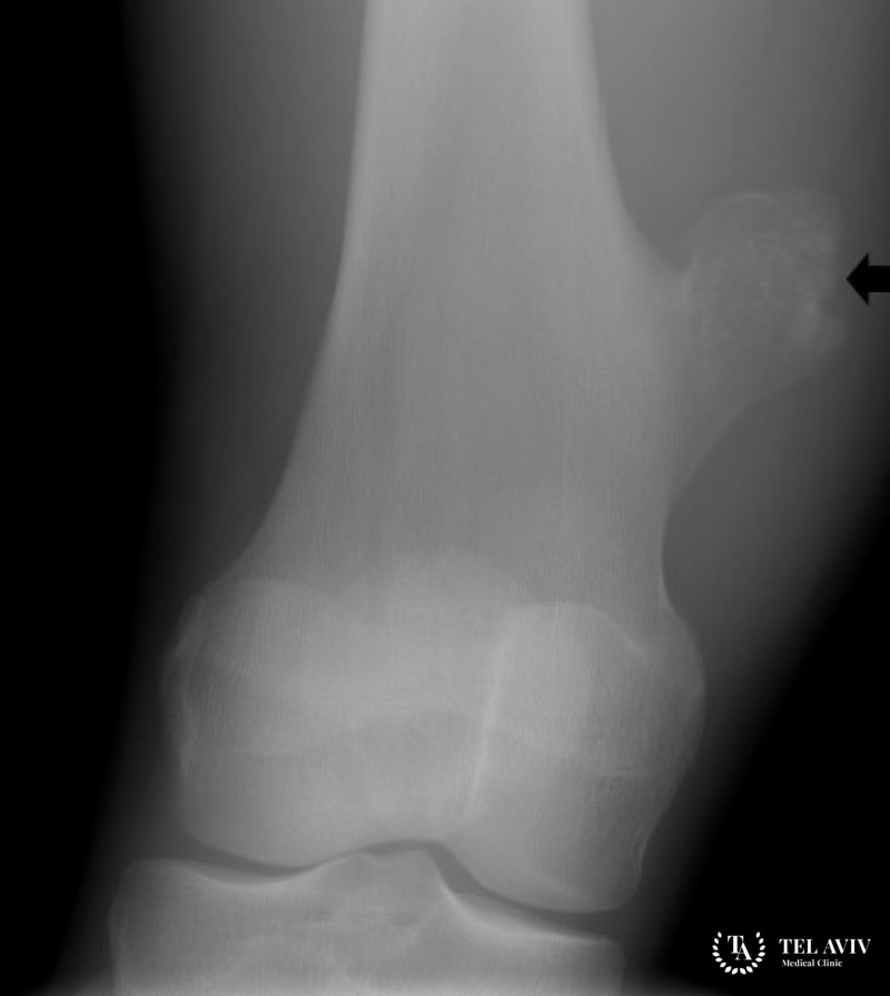 Остеохондрома - симптоматика и лечение