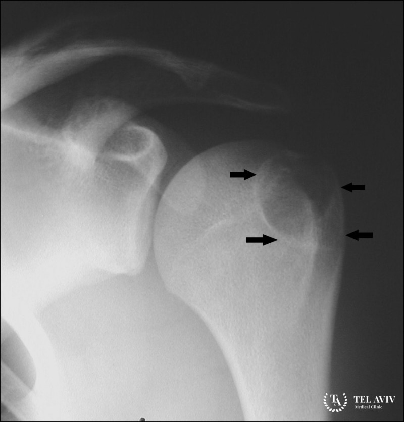 Хондробластома - симптоматика и лечение
