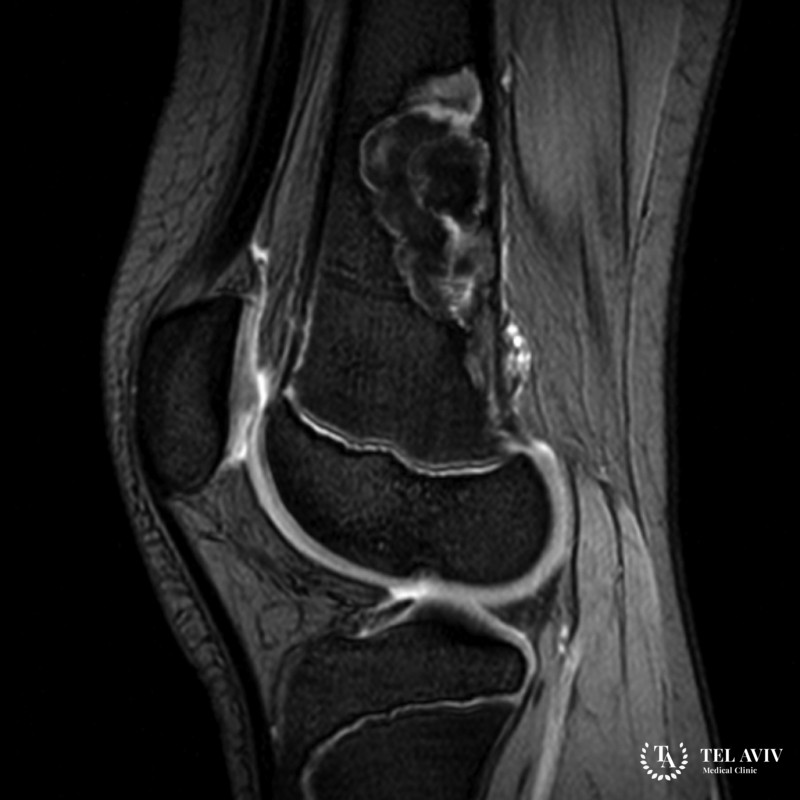 Хондромиксоидная фиброма - диагностика и лечение