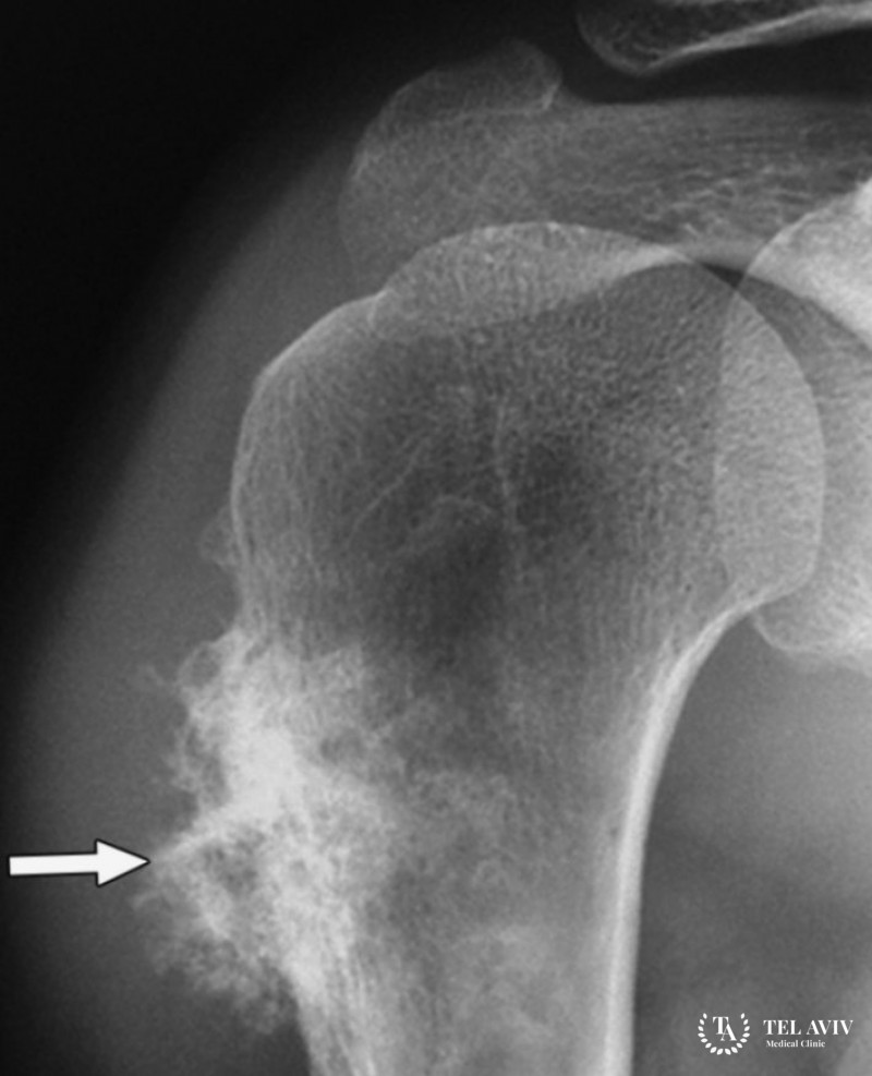 Злокачественная фиброзная гистиоцитома: симптоматика, диагностика, лечение
