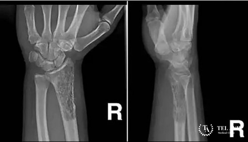 Лейомиосаркомы – признаки, обследование, лечение
