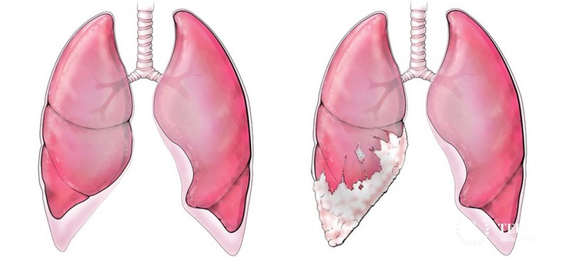 Мультикистозная мезотелиома