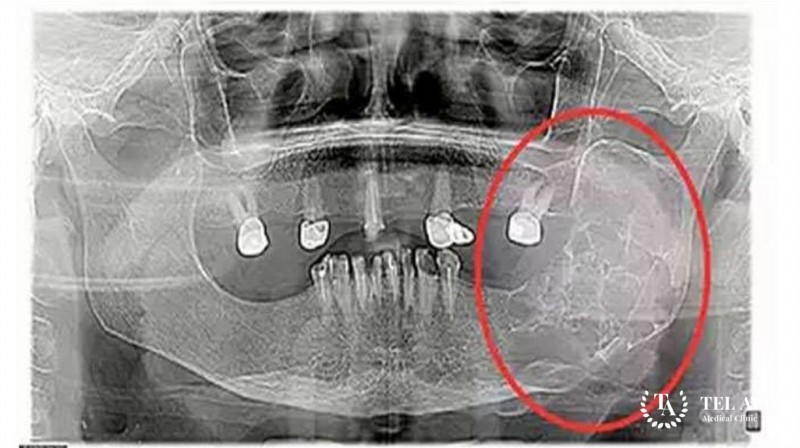 Остеобластокластома (гигантоклеточная опухоль)