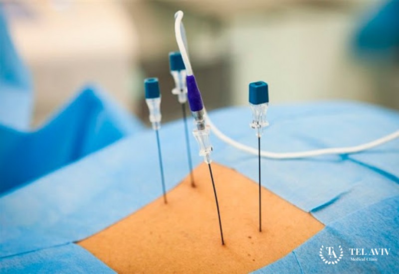 Радиочастотная термоаблация (РЧА)