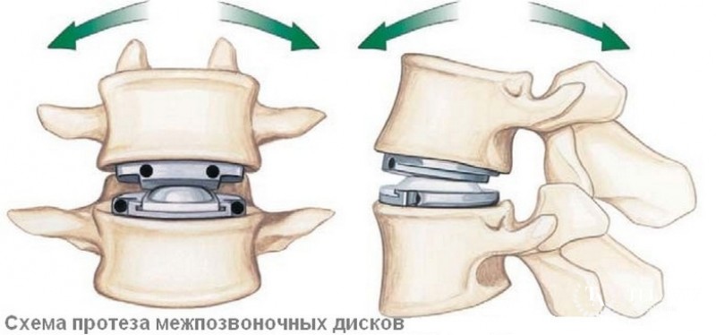 Эндопротезирование позвонков