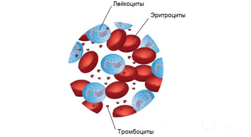 Миелодиспластический синдром